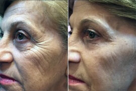 Prima e dopo l'utilizzo di 3 Bioretin